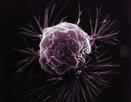 Closeup image of a breast cancer cell. (Photo courtesy National Cancer Institute)