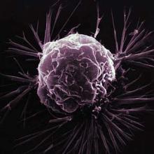 Closeup image of a breast cancer cell. (Photo courtesy National Cancer Institute)