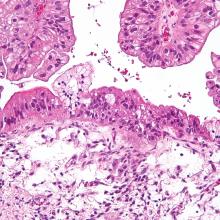 Ovarian cancer cells (Photo Nephron via Wikimedia Commons)