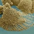Dying cancer cell from NIH microscopy