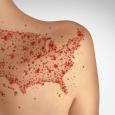 Measles infections send 1 in 5 people to the hospital. 